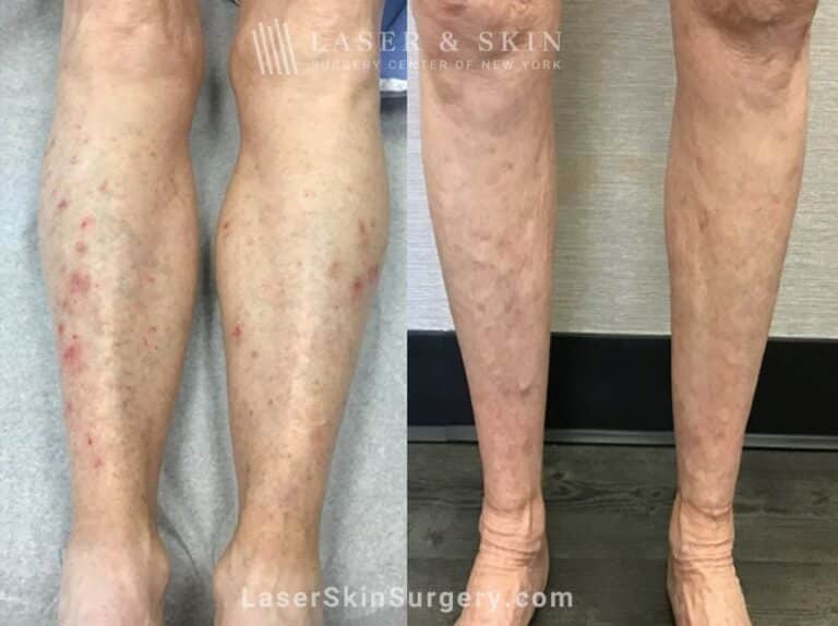 Fraxel for Skin Rejuvenation on the Legs