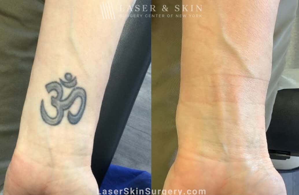 PicoPlus Treatments for Tattoo Removal on the Wrist