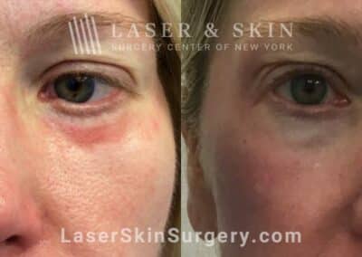 Vbeam Laser Treatments for Scarring Beneath the Eyes