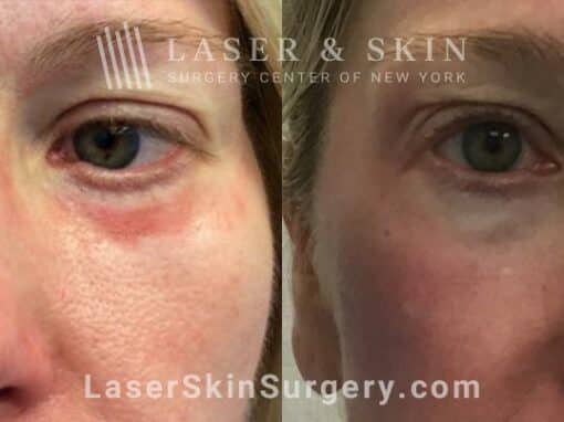 Vbeam Laser Treatments for Scarring Beneath the Eyes