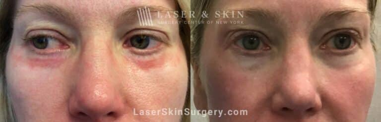 Vbeam Laser Treatments for Scarring Beneath the Eyes