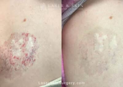 Excel V and Vbeam to treat Hemangioma