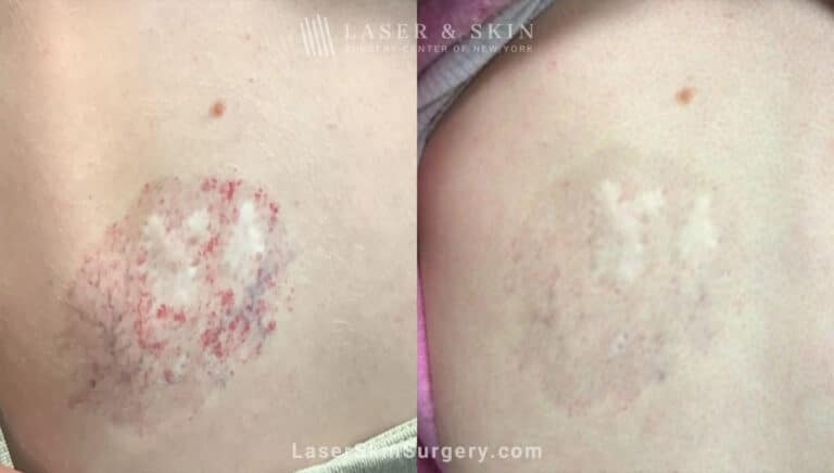 Excel V and Vbeam to treat Hemangioma