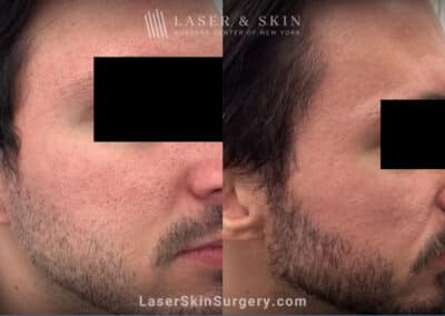 CO2 Laser Treatments for Acne Scarring on the Face