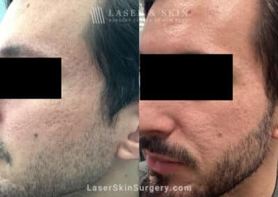 CO2 Laser Treatments for Acne Scarring on the Face