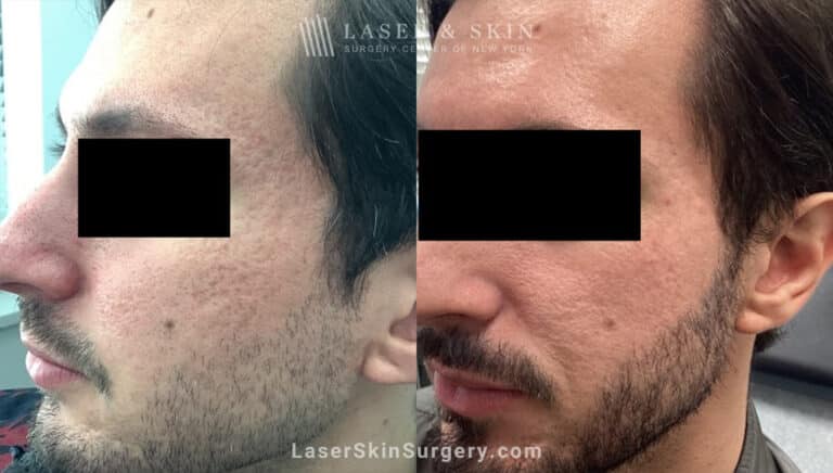 CO2 Laser Treatments for Acne Scarring on the Face