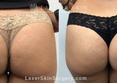 CoolTone Treatments for Muscle Stimulation and Growth, Skin Tightening, and Cellulite Reduction