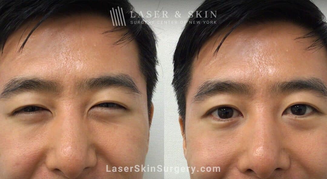 Daxxify Treatment to Smooth Wrinkles and Rejuvenate the Skin