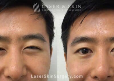 Daxxify Treatment to Smooth Wrinkles and Rejuvenate the Skin