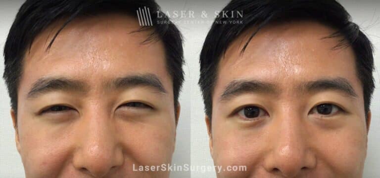 Daxxify Treatment to Smooth Wrinkles and Rejuvenate the Skin