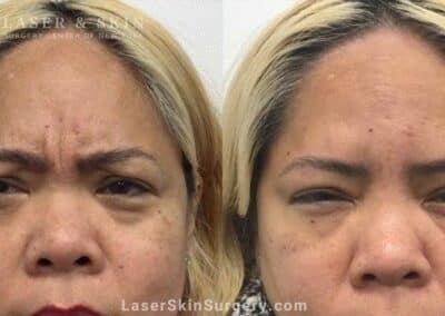 Daxxify to Treat Glabellar Lines Between the Eyebrows