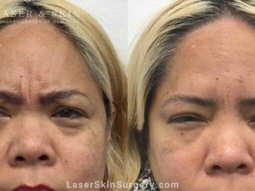 Daxxify to Treat Glabellar Lines Between the Eyebrows