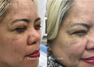 Daxxify Treatments to Minimize the Appearance of Wrinkles