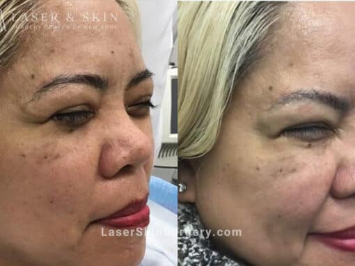 Daxxify Treatments to Minimize the Appearance of Wrinkles