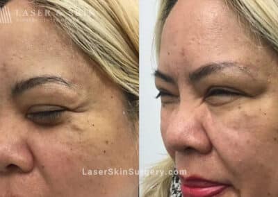 Daxxify to Treat Wrinkle Formation in the Upper Face