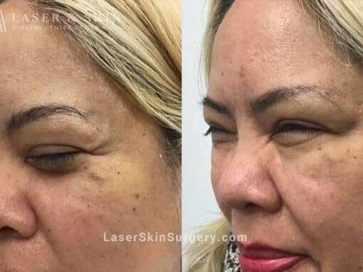 Daxxify to Treat Wrinkle Formation in the Upper Face