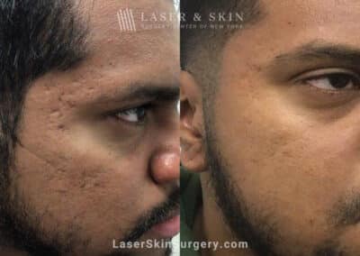 Genius Microneedling Treatments to Reduce Acne Scarring