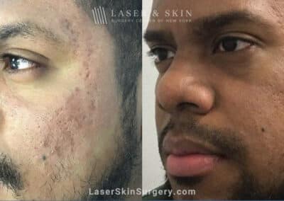 Genius Microneedling Treatments to Reduce Acne Scarring