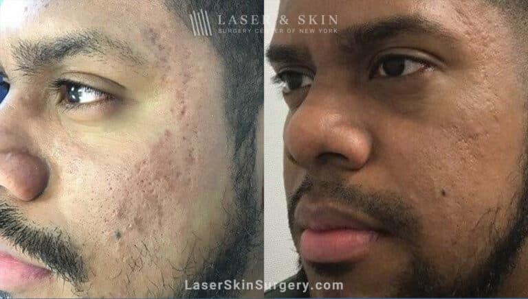 Genius Microneedling Treatments to Reduce Acne Scarring