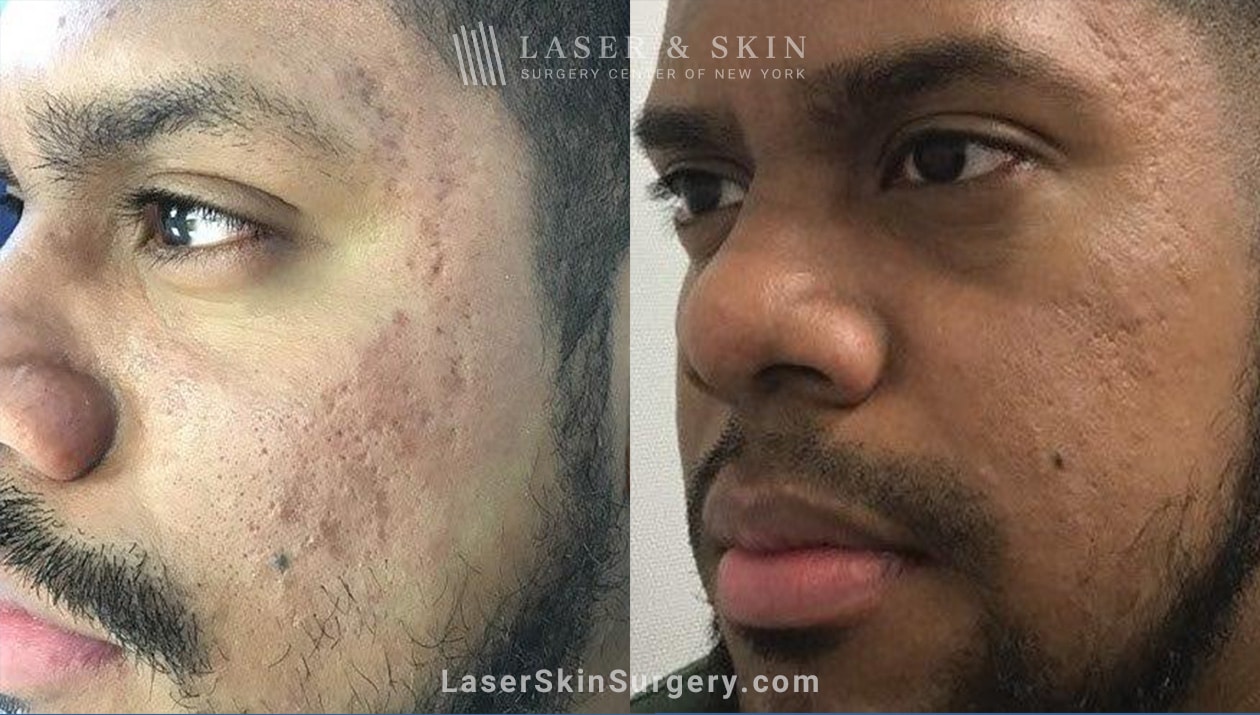 Guide to Acne and Facial Scars New York, NY Laser Center