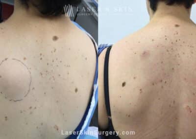 Treatment for Lipoma Near Shoulder Blade