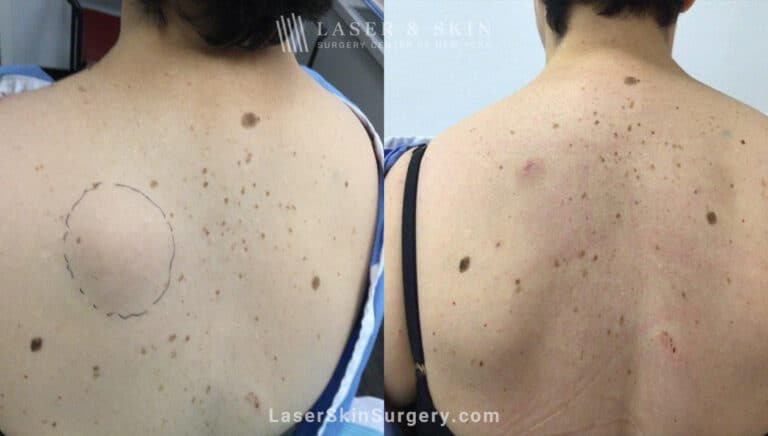 Treatment for Lipoma Near Shoulder Blade