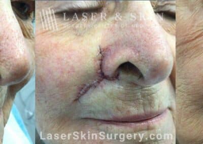 Mohs Surgery to Treat Skin Cancer Near the Nose