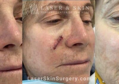 Mohs Surgery to Treat Skin Cancer on the Cheek
