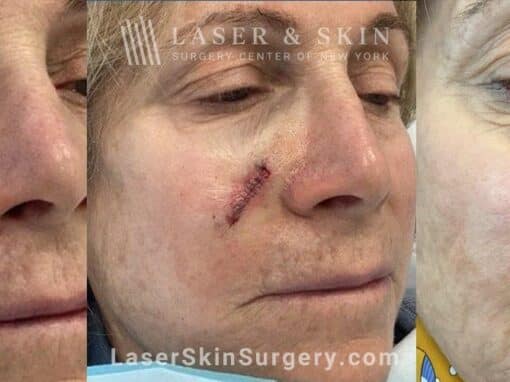 Mohs Surgery to Treat Skin Cancer on the Cheek