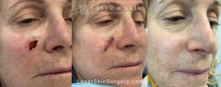 Mohs Surgery to Treat Skin Cancer on the Cheek