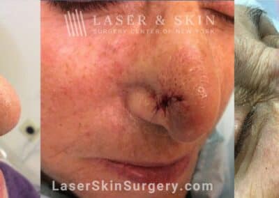 Mohs Surgery to Treat Skin Cancer on the Nose