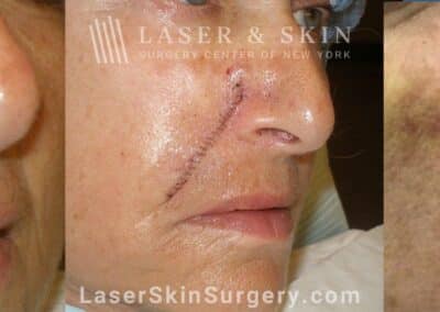 Mohs Surgery to Treat Skin Cancer on the Cheek Near the Nose