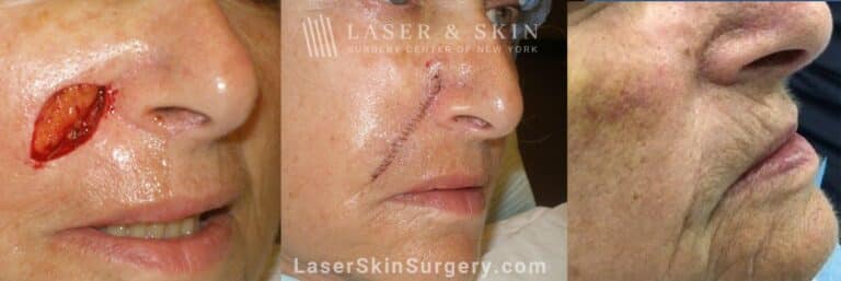 Mohs Surgery to Treat Skin Cancer on the Cheek Near the Nose