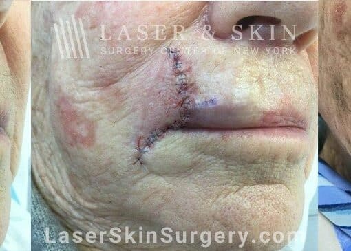 Mohs Surgery to Treat Skin Cancer on the Lip