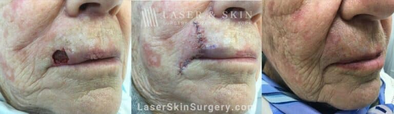 Mohs Surgery to Treat Skin Cancer on the Lip