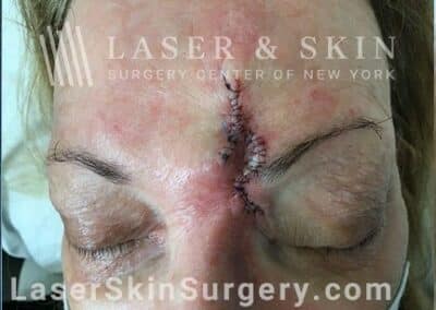Mohs Surgery to Treat Skin Cancer Above the Eyebrow