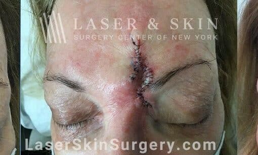 Mohs Surgery to Treat Skin Cancer Above the Eyebrow