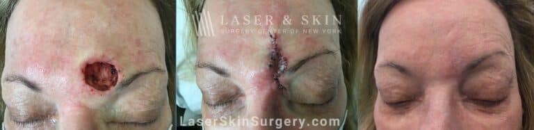 Mohs Surgery to Treat Skin Cancer Above the Eyebrow