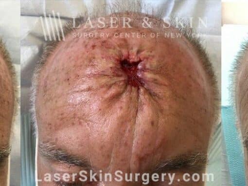 Mohs Surgery to Treat Skin Cancer on Top of the Head