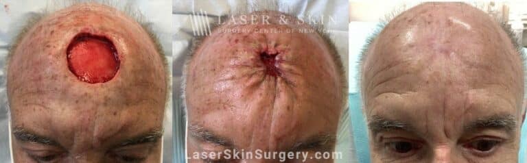 Mohs Surgery to Treat Skin Cancer on Top of the Head