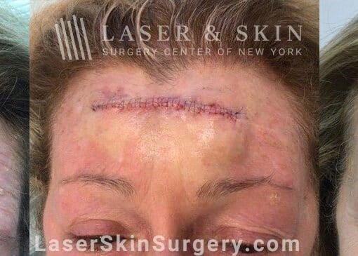 Mohs Surgery to Treat Skin Cancer on the Forehead