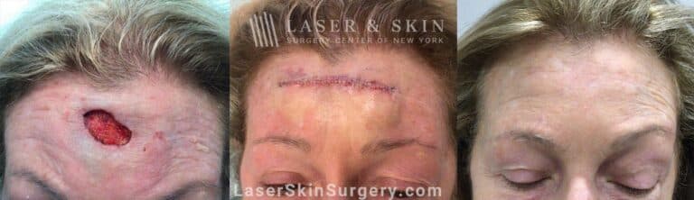 Mohs Surgery to Treat Skin Cancer on the Forehead