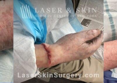 Mohs Surgery to Treat Skin Cancer on the Wrist