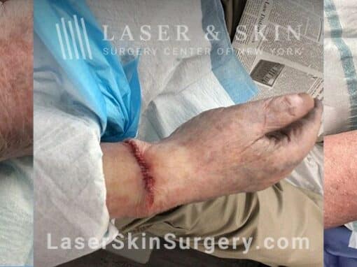 Mohs Surgery to Treat Skin Cancer on the Wrist