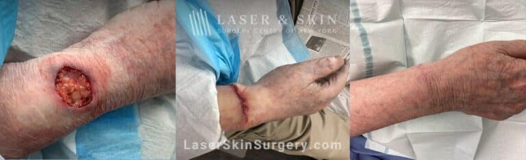 Mohs Surgery to Treat Skin Cancer on the Wrist