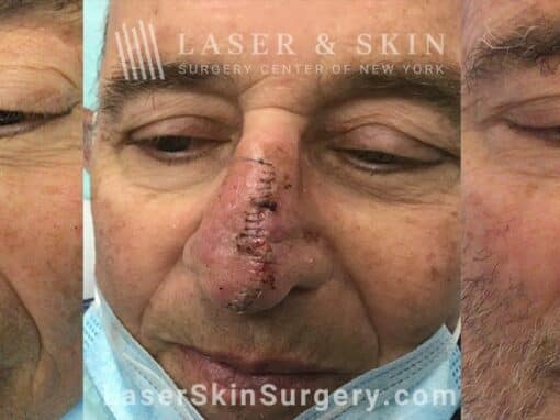 Mohs Surgery to Treat Skin Cancer on the Nose