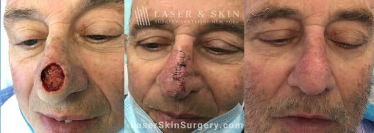 Mohs Surgery to Treat Skin Cancer on the Nose