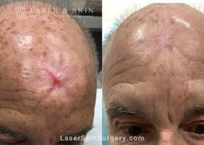 Vbeam Treatments for Mohs Scar on Patient’s Head