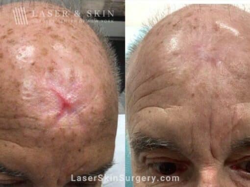 Vbeam Treatments for Mohs Scar on Patient’s Head