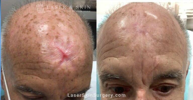 Vbeam Treatments for Mohs Scar on Patient’s Head